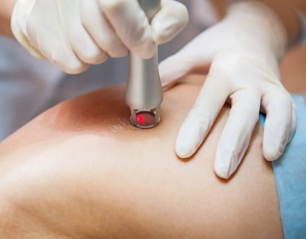 Eine Laserbehandlung der Haut