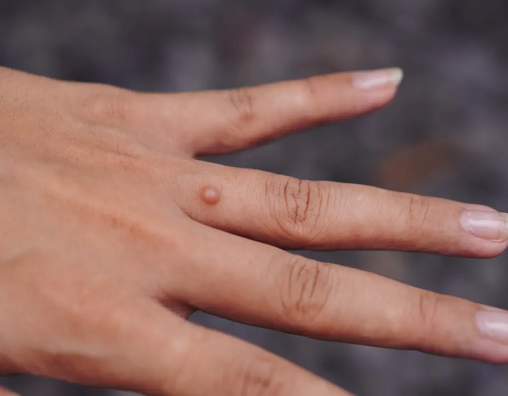 Hautzentrum Kurpark Muttermale Nahaufnahme einer Hand; einer der Finger hat eine Warze