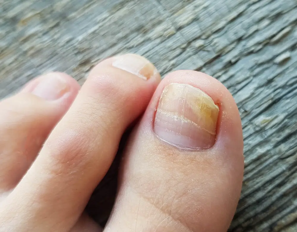 Hautzentrum Kurpark Nagelpilz Nahaufname von Zehen, der Nagel am großen Zeh zeigt eine auffällige Verfärbung